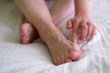 Téléchargez les photos : Jambes féminines avec problème avec les pieds des femmes, orteils d'oignon dans les pieds nus. Hallus valgus, gros plan - en image libre de droit