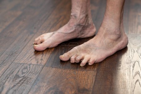 Photo for Mans deformed hammertoes showing left foot one year after surgery showing multiple conditions including toenail fungus and phlebitis. - Royalty Free Image