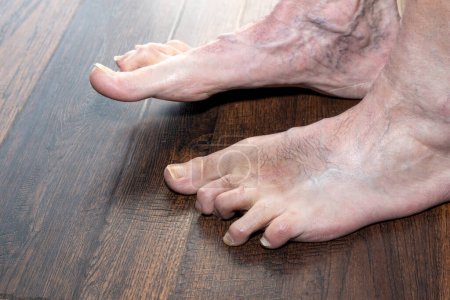Téléchargez les photos : Hommes marteaux déformés montrant le pied gauche un an après la chirurgie montrant de multiples conditions, y compris le champignon ongle du pied et la phlébite. - en image libre de droit