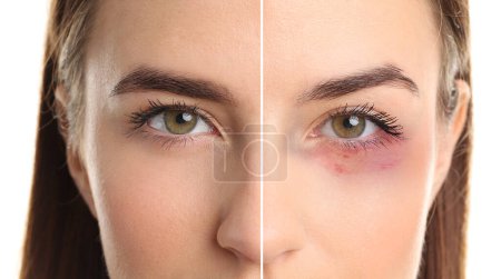 Photo for Face of young woman with and without bruise under eye on white background, closeup - Royalty Free Image