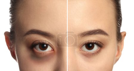 Photo for Face of young woman with and without bruise under eye on white background, closeup - Royalty Free Image