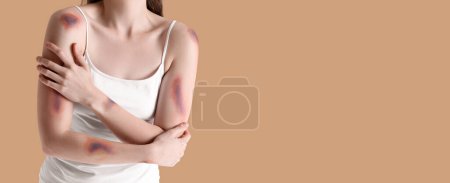 Photo for Young woman with bruises against beige background with space for text - Royalty Free Image