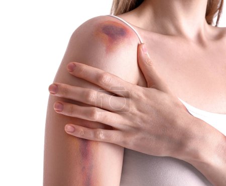 Photo for Young woman with bruised arm on white background, closeup - Royalty Free Image