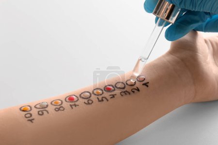 Foto de Médico haciendo la prueba de la piel de la alergia en la mano del paciente en la clínica, primer plano - Imagen libre de derechos