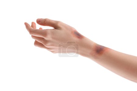 Blutergüsse weibliche Hand auf weißem Hintergrund