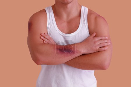 Photo for Man with bruises on arm against beige background - Royalty Free Image