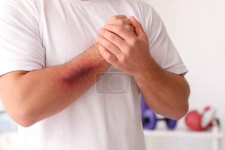 Sporty man with bruises on body in gym, closeup