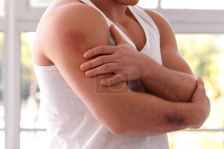 Sporty man with bruises on body in gym, closeup