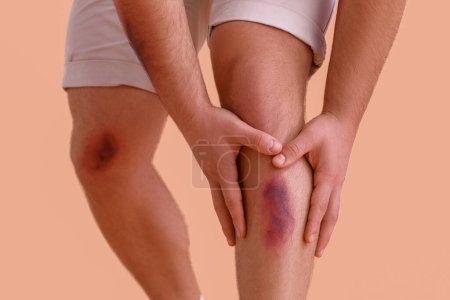 Photo for Man with bruises on legs against beige background, closeup - Royalty Free Image