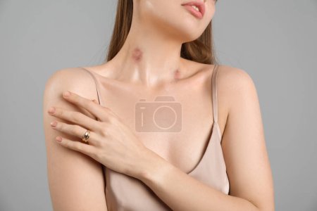 Foto de Hermosa mujer con mordeduras de amor en su cuello sobre fondo gris, primer plano - Imagen libre de derechos