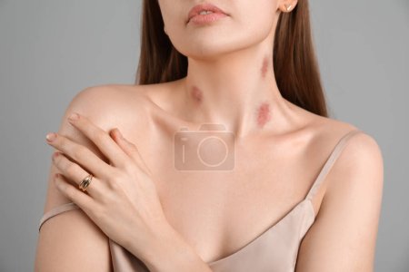 Photo for Young woman with love bites on her neck against grey background, closeup - Royalty Free Image