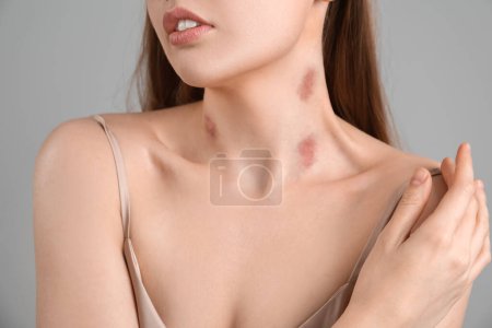 Foto de Mujer joven con mordeduras de amor en el cuello sobre fondo gris, primer plano - Imagen libre de derechos