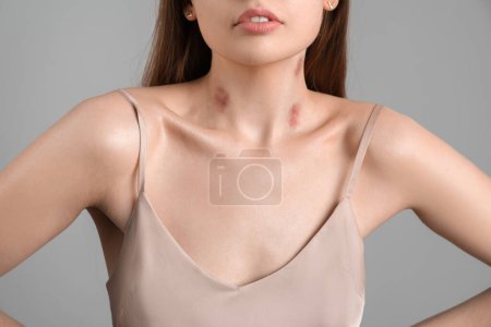 Foto de Mujer joven con mordeduras de amor en el cuello sobre fondo gris, primer plano - Imagen libre de derechos