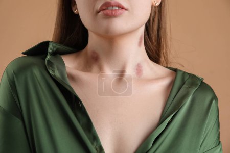 Foto de Mujer joven con mordeduras de amor en su cuello contra el fondo de color, primer plano - Imagen libre de derechos