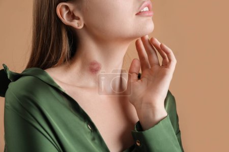 Photo for Young woman with love bite on her neck against color background, closeup - Royalty Free Image