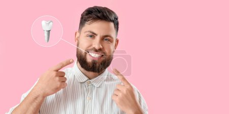 Téléchargez les photos : Jeune homme avec des dents implantées sur fond rose - en image libre de droit