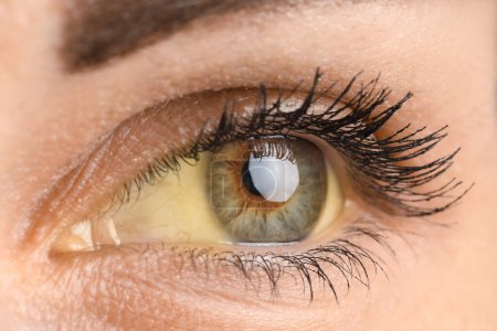 Foto de Young woman with yellow eyes, closeup. Hepatitis symptom - Imagen libre de derechos