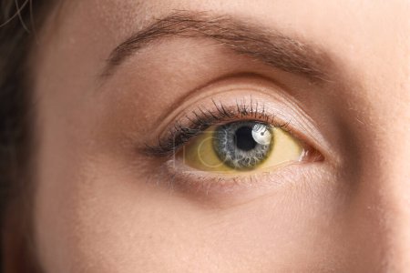 Foto de Mujer joven con ojos amarillos, primer plano. Síntoma de la hepatitis - Imagen libre de derechos