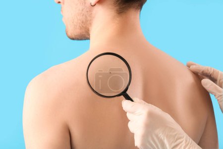 Foto de Dermatólogo examinando lunar en la espalda del joven con lupa sobre fondo azul, primer plano - Imagen libre de derechos