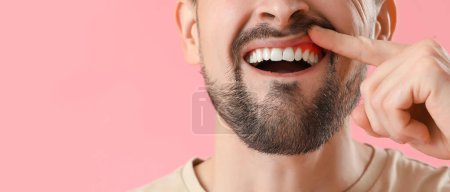 Foto de Hombre con inflamación de las encías sobre fondo rosa, primer plano - Imagen libre de derechos