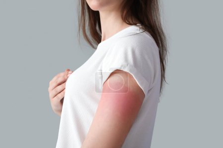 Téléchargez les photos : Jeune femme allergique avec peau brûlée par le soleil sur fond gris, gros plan - en image libre de droit
