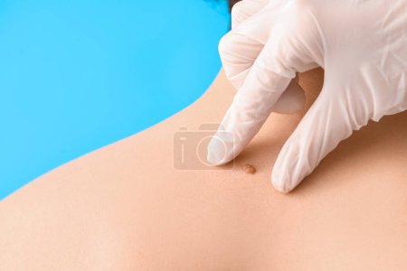 Photo for Dermatologist examining mole on young man's back against blue background, closeup - Royalty Free Image