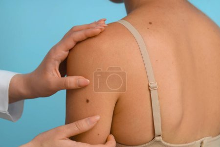 Dermatologist examining young woman's mole on blue background, closeup