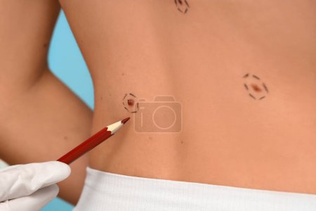 Photo for Dermatologist marking young woman's mole on blue background, closeup - Royalty Free Image