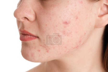Téléchargez les photos : Adolescente avec problème d'acné sur fond blanc, gros plan - en image libre de droit