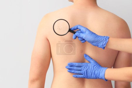 Photo for Dermatologist with magnifier examining moles on young man's back against light background, closeup - Royalty Free Image