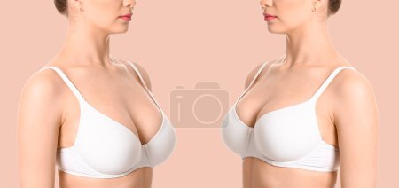 Téléchargez les photos : Femme avant et après correction de la taille des seins sur fond beige. Concept de chirurgie plastique - en image libre de droit