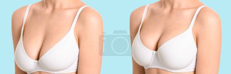 Téléchargez les photos : Femme avant et après correction de la taille des seins sur fond bleu clair. Concept de chirurgie plastique - en image libre de droit