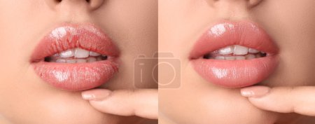 Téléchargez les photos : Jeune femme avant et après le traitement des lèvres sèches, gros plan - en image libre de droit