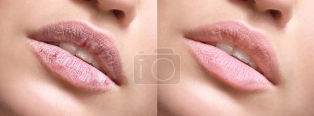 Téléchargez les photos : Jeune femme avant et après le traitement des lèvres sèches, gros plan - en image libre de droit