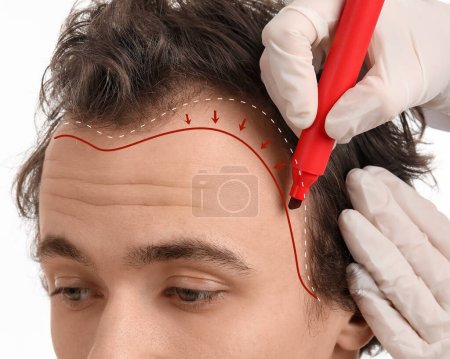 Foto de Médico que marca la frente del hombre joven con problema de pérdida de cabello en el fondo blanco, primer plano - Imagen libre de derechos