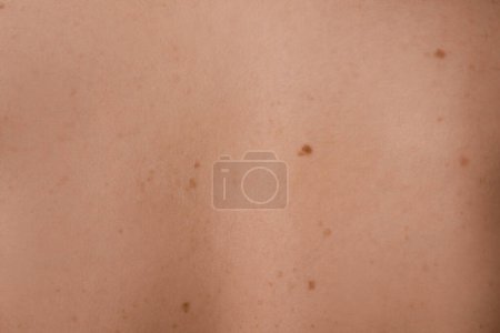 Téléchargez les photos : Vue rapprochée de la peau de la femme avec des taupes - en image libre de droit