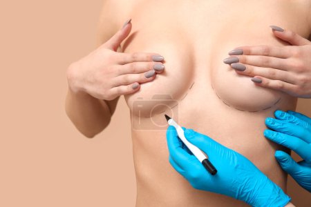 Téléchargez les photos : Docteur dessin marques sur le sein féminin avant l'opération de chirurgie esthétique sur fond brun - en image libre de droit