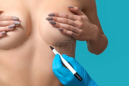 Téléchargez les photos : Docteur dessin marques sur le sein féminin avant l'opération de chirurgie esthétique sur fond bleu - en image libre de droit