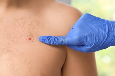Téléchargez les photos : Dermatologue pointant vers la taupe marquée sur la poitrine du jeune homme à la clinique, gros plan - en image libre de droit