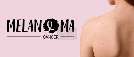 Téléchargez les photos : Jeune femme avec taupes et texte MELANOMA CANCER sur fond rose - en image libre de droit