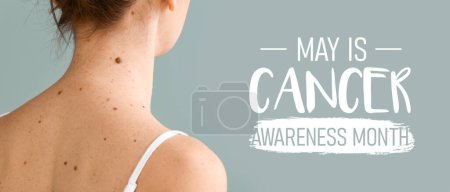 Photo for Young woman with moles on grey background. Banner for Melanoma Cancer Awareness Month - Royalty Free Image