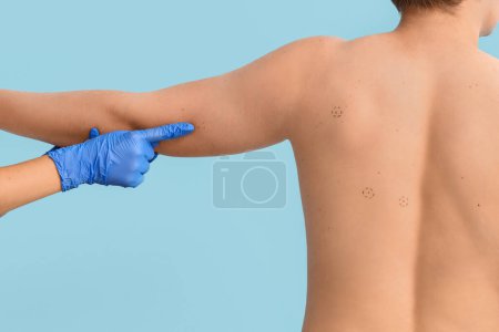 Téléchargez les photos : Dermatologue pointant les taupes sur le bras du jeune homme sur fond bleu, vue de dos - en image libre de droit