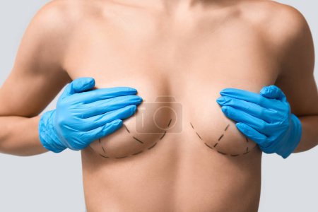 Téléchargez les photos : Jeune femme avec des marques sur le sein pour l'opération de chirurgie esthétique sur fond gris - en image libre de droit