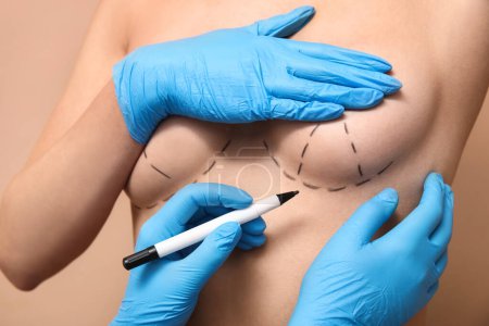 Téléchargez les photos : Docteur dessin marques sur le sein féminin avant l'opération de chirurgie esthétique sur fond brun - en image libre de droit