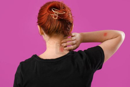 Young woman with mosquito bite on purple background, back view