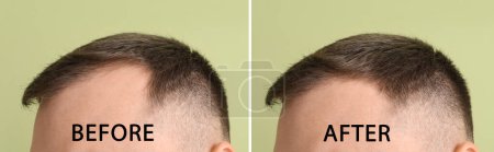 Téléchargez les photos : Jeune homme avant et après traitement de perte de cheveux sur fond de couleur, gros plan - en image libre de droit