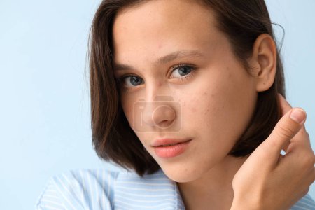 Schöne junge Frau mit Akne-Problem auf blauem Hintergrund