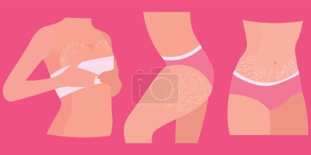 Women with stretch marks on their bodies against pink background