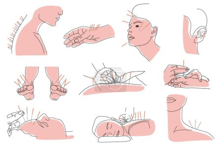 Ilustración de Set of people undergoing acupuncture on white background - Imagen libre de derechos
