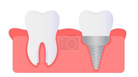 Natural and implanted teeth in gum on white background